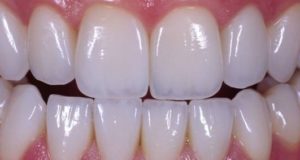 Почему керамические коронки на зубы лучше?