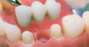 Протезирование зубов